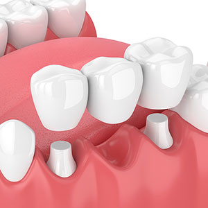 dental bridge restoration
