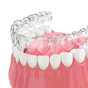 clear dental braces aligners