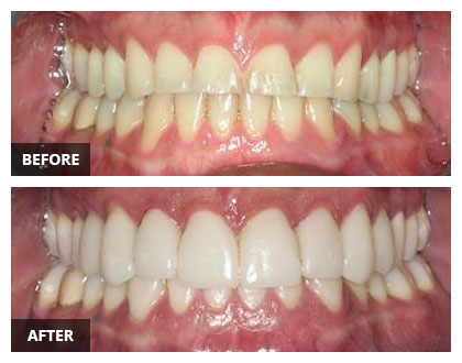 porcelain dental crowns and teeth whitening