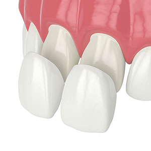cosmetic dental veneers on front teeth